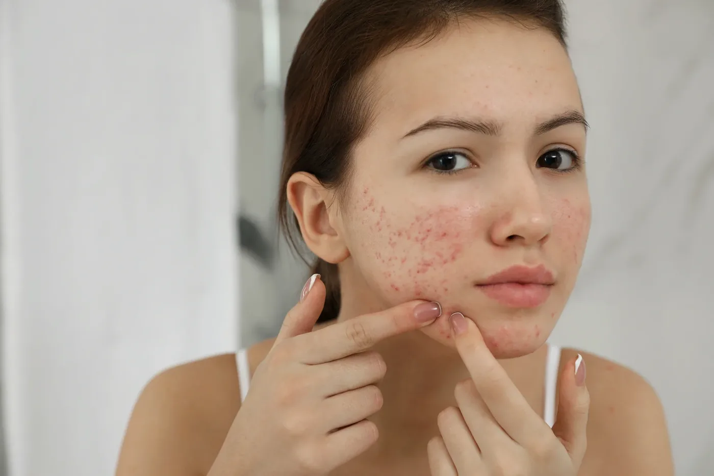 Bạn trẻ đưa tay nặn mụn trên má