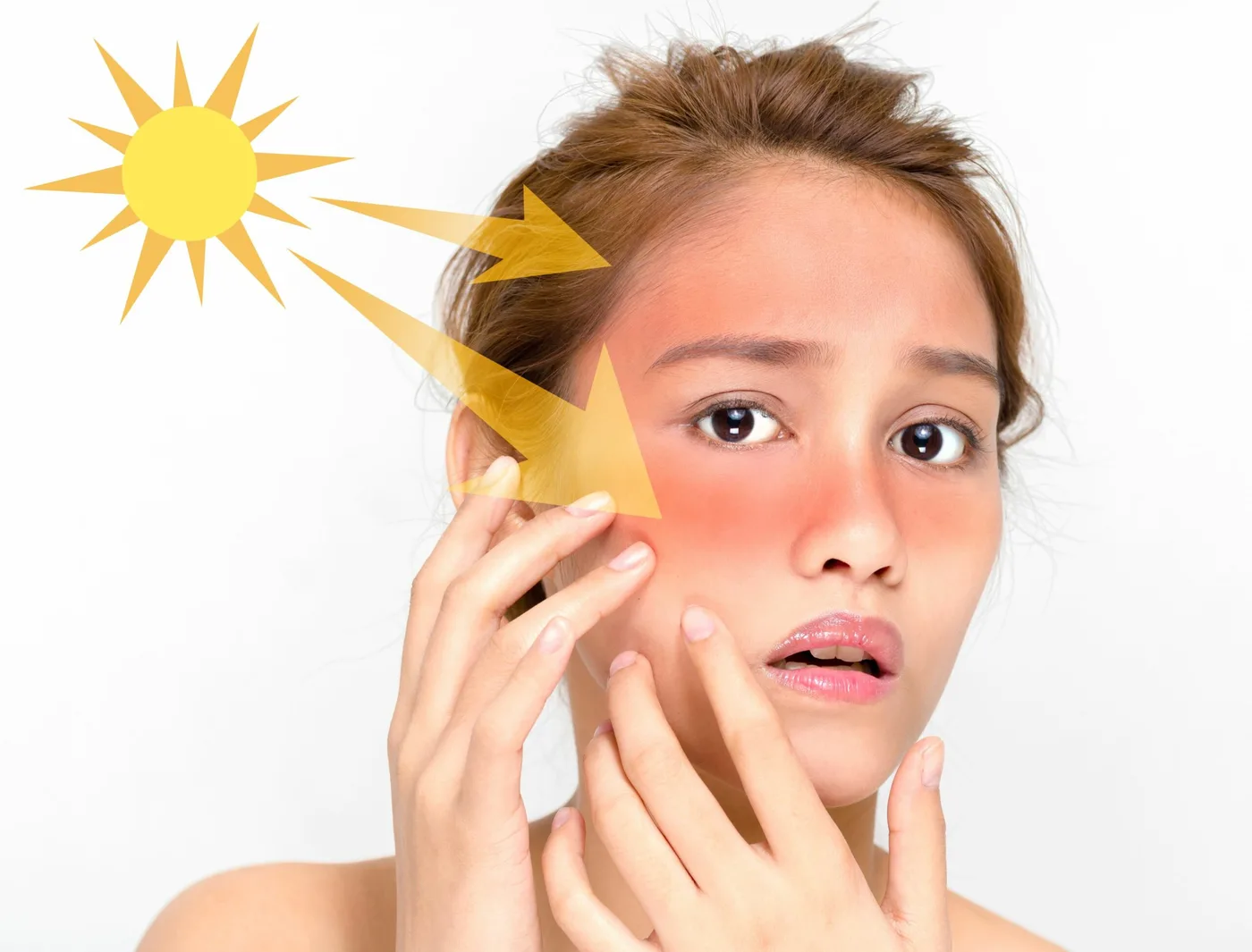 Da mặt đỏ rát do ánh nắng chiếu trực tiếp, kèm hình minh họa mặt trời