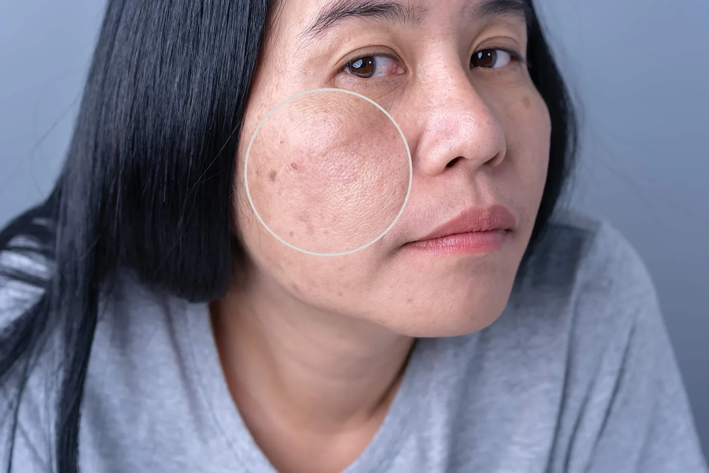 Vùng má có các mảng và đốm nâu, được khoanh tròn để quan sát