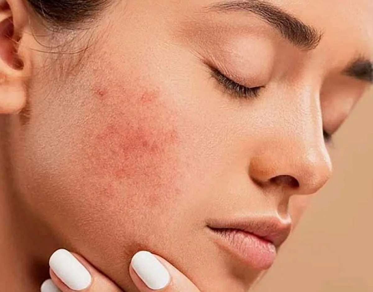 Vùng má hơi ửng đỏ, dấu hiệu da đang bị kích ứng