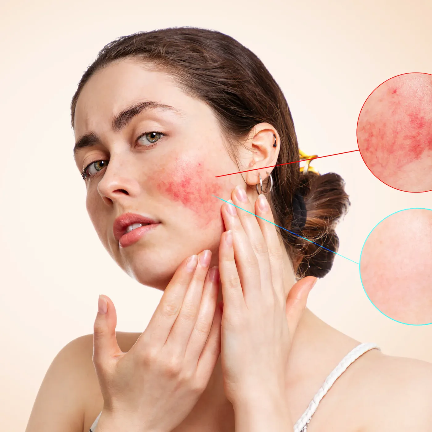 Vùng má ửng đỏ do kích ứng, kèm hình phóng to so sánh vùng da đỏ và vùng da bình thường