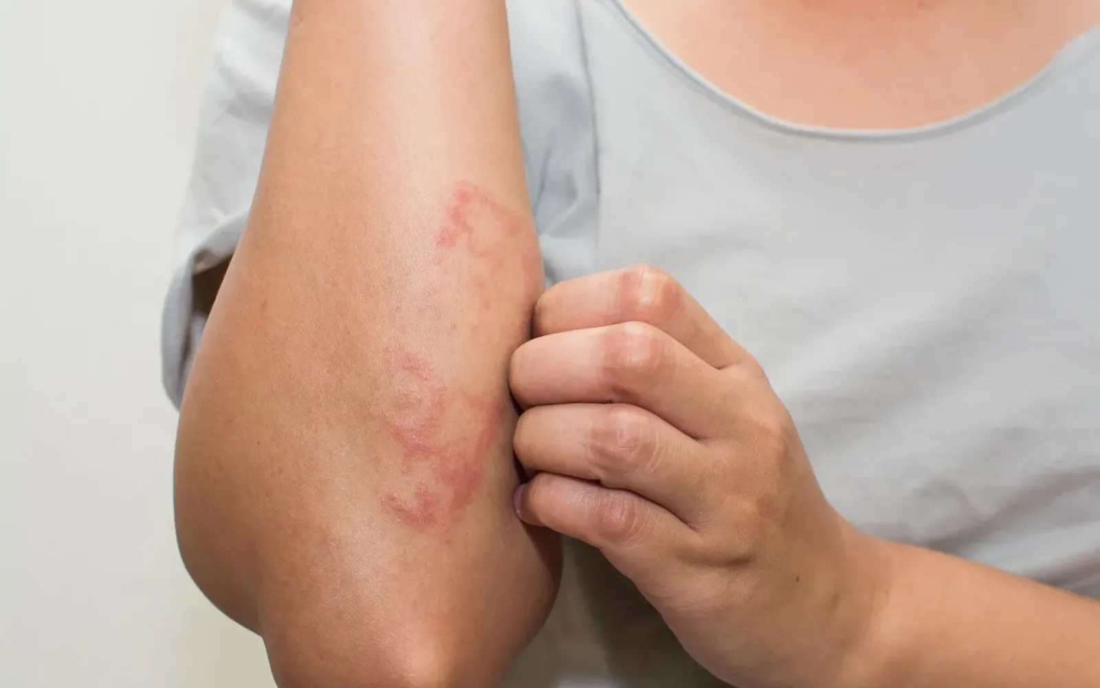 Cánh tay nổi mảng đỏ, người bệnh đang gãi vùng da ngứa