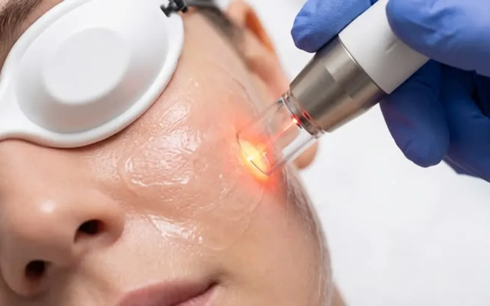 Bác sĩ thực hiện laser trên da mặt, người được làm đeo kính bảo vệ mắt